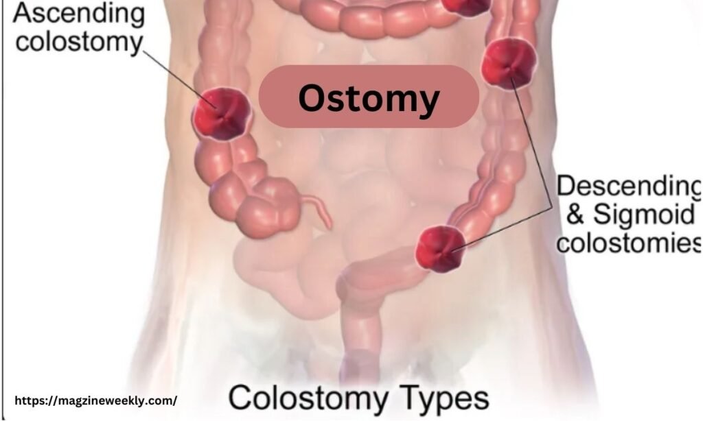 Ostomy